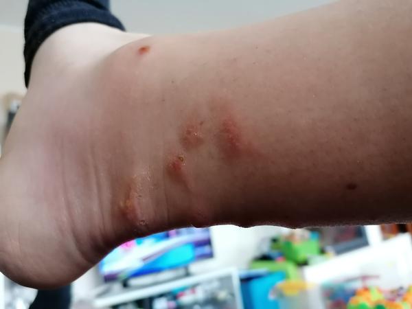 Alergická reakcia na bodnutie hmyzom?