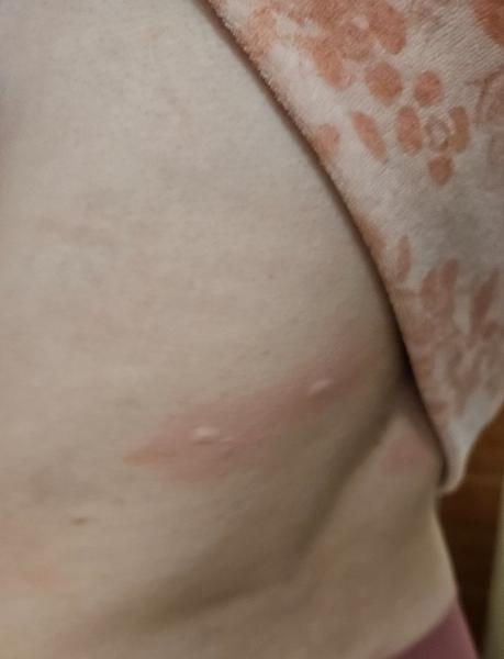 Ako sa zbaviť nočných štípancov na chrbte?