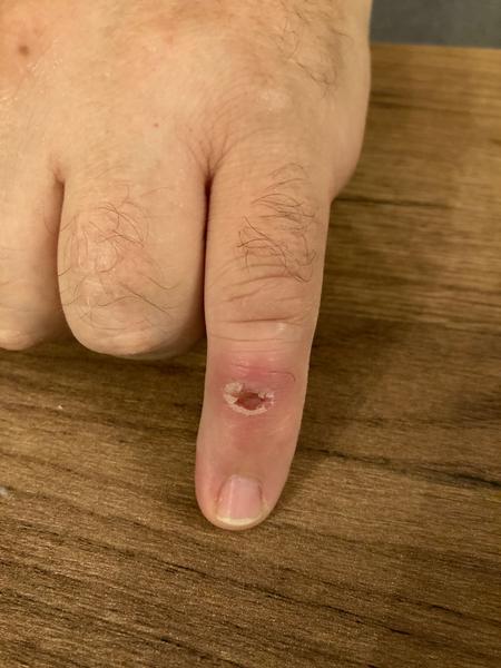 Prečo ostala manželovi na prste jamka po rane?