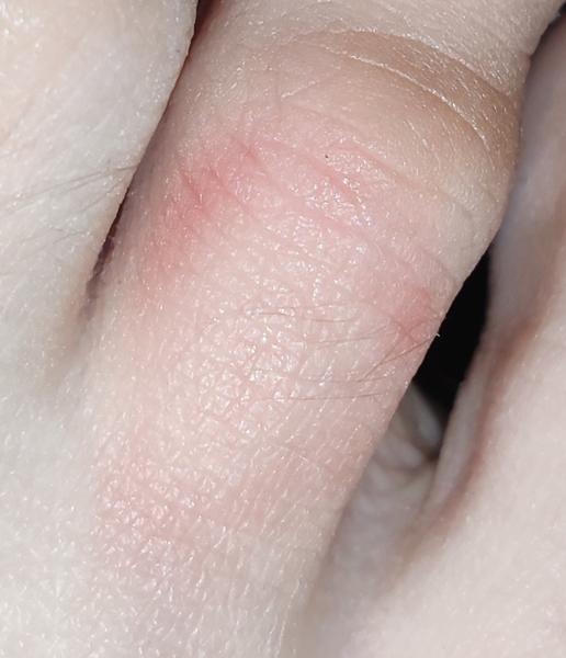 Je to príznak boreliózy alebo niečo iné?