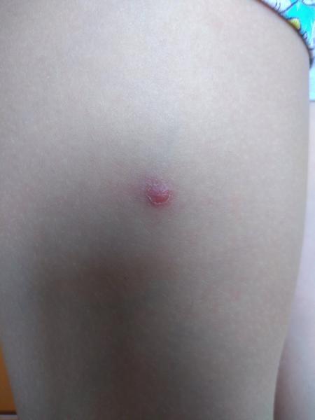 Má moje dieťa molusky?