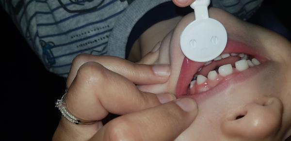 Sú škvrny na zuboch dvojročného chlapca v poriadku?