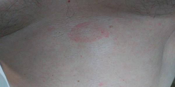 Čo sú to za vyrážky?