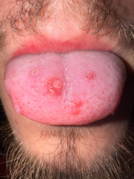 Vredy na jazyku a opuchnuté ďasná