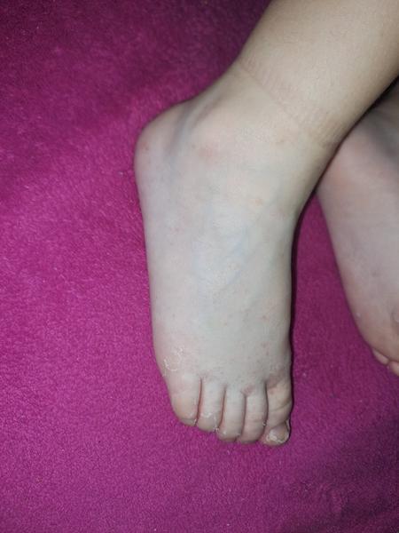 Syn má opakujúce sa vyrážky – čo môže byť príčinou?