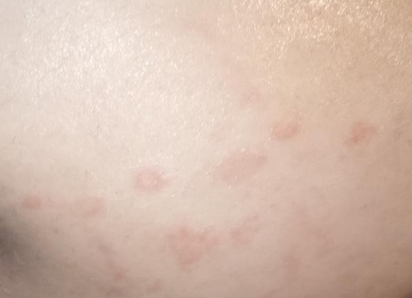 Vyrážky na bruchu