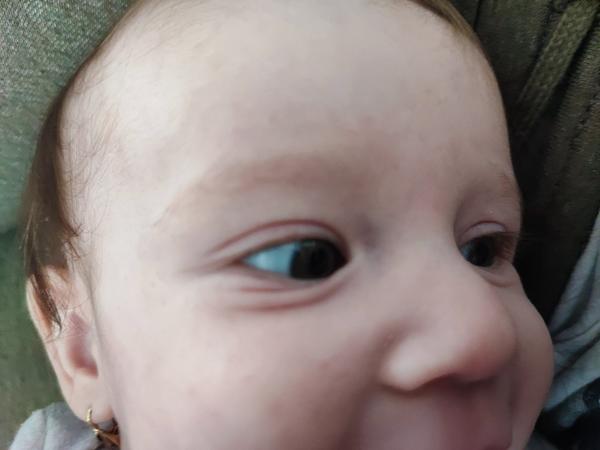 Prečo má 7-mesačná dcérka sfarbené očné bielka do modra?