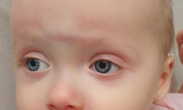 Ako urýchliť liečbu hrčky po údere 15 mesačnej dcérky?