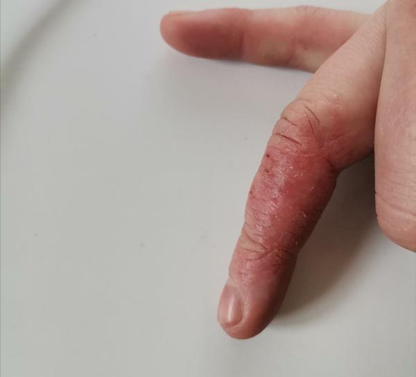 Zapálené pľuzgiere na prstoch