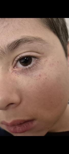 Čo robiť pri červených bodkách pod očami?