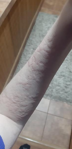 Žihlavka v tehotenstve