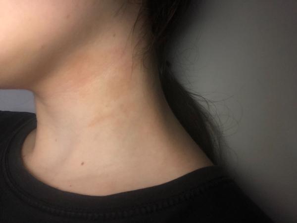 Čo spôsobuje červené fľaky na krku?