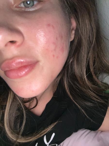 Prečo mám opuch na hornej pere po aplikácii výplne?