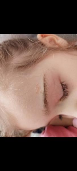 Ako odstrániť znamienko nad obočím u dieťaťa?