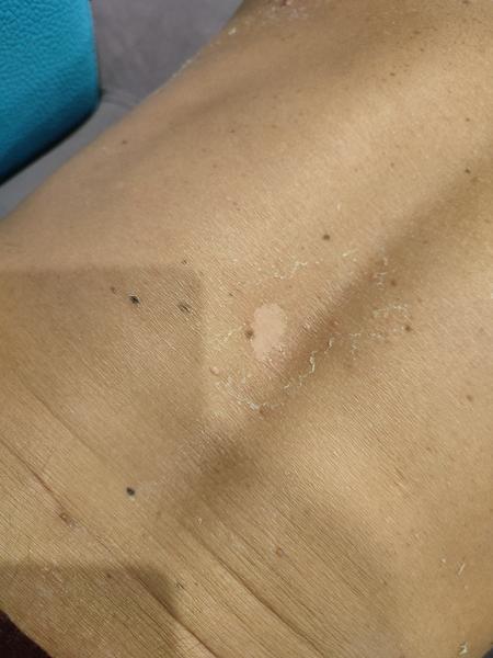 Sú moje čierne znamienka nebezpečné?