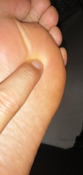 Možné príčiny bolesti chodidla pri chôdzi naboso