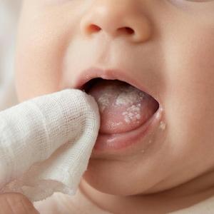 Bábätko odmieta piť a plače? Skontrolujte, či nemá biely jazýček!