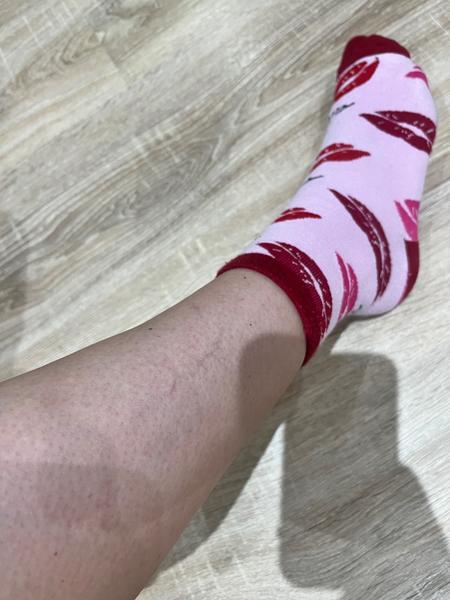 Je bolestivá žilka na lýtku normálna?