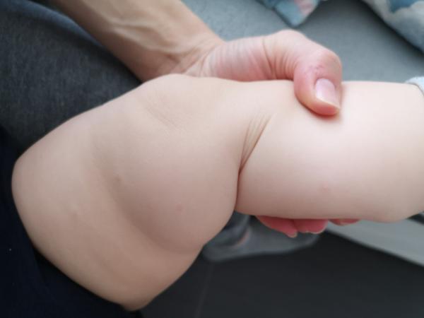 Štípance alebo vyrážky?