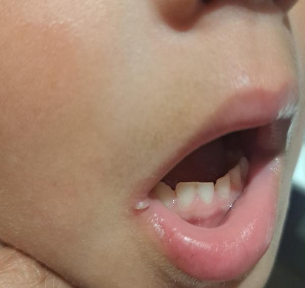 Opuch na perách u dieťaťa