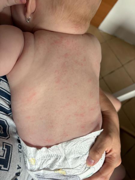 Môže alergická reakcia súvisieť s príkrmom z mrkvy?