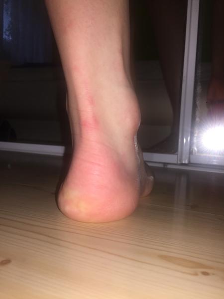 Bolesť chodidla - mám zápal šliach?