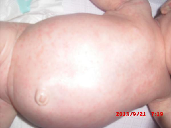 Čo sú tieto červené vyrážky?