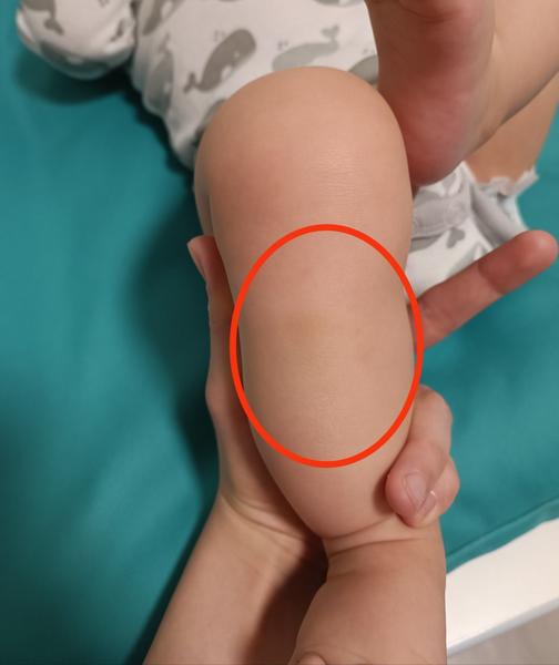 Modrina na nohe bábätka