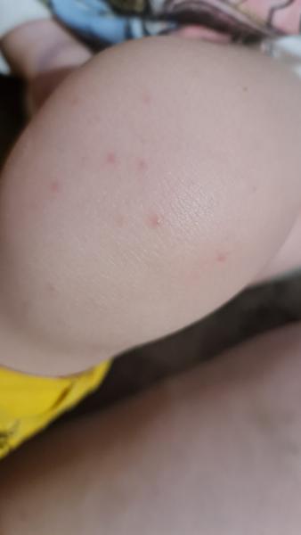 Je to kurie oko či ovčie kiahne?