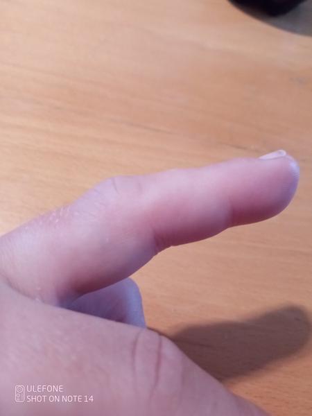 Poštipnutie včelou a opuch