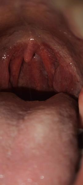 Čo spôsobuje pocit škrabania na mandlí?