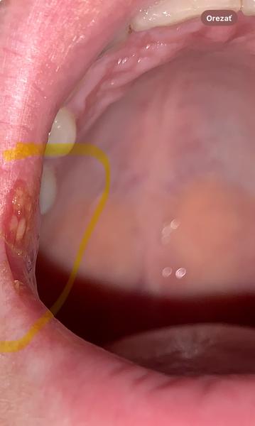 Ako liečiť bolestivý kútik úst?