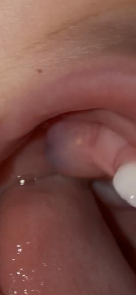 Veľká fialová buľa pri prerezávaní zubu u 13-mesačného