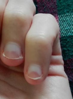 Aký problém znamenajú tieto nechty?