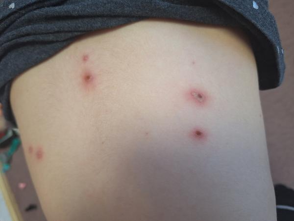 Je hojenie po kiahňach v poriadku?