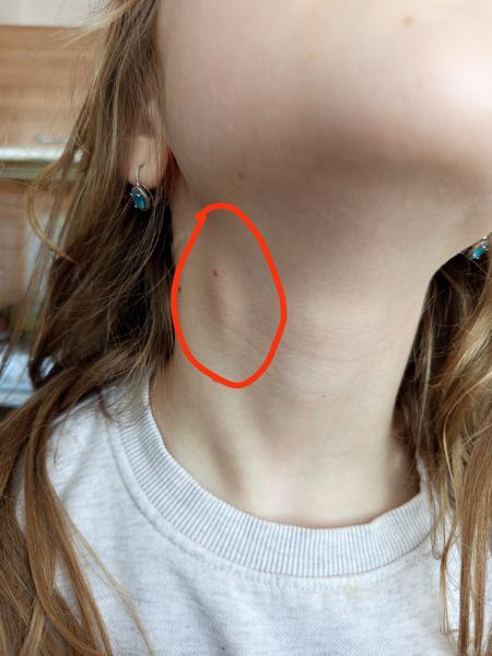 Uzlina na krku u dcérky