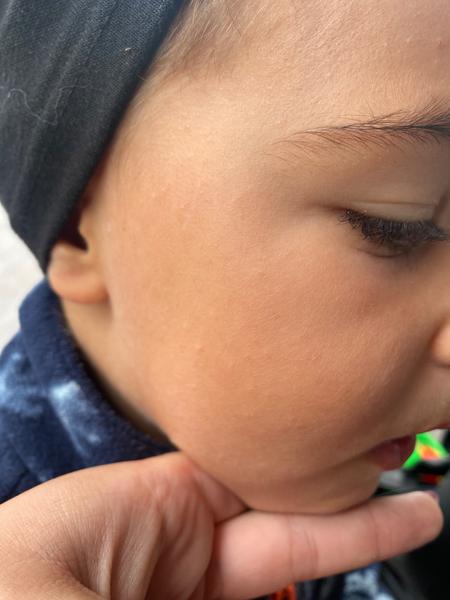 Čo za vyrážky má môj syn?