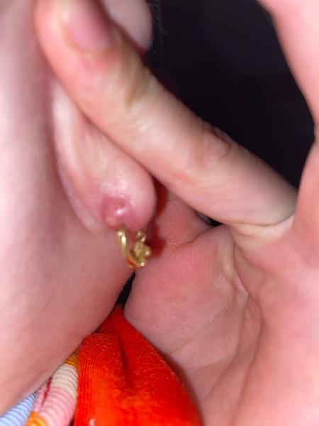 Ako liečiť zapálenú dierku v uchu?