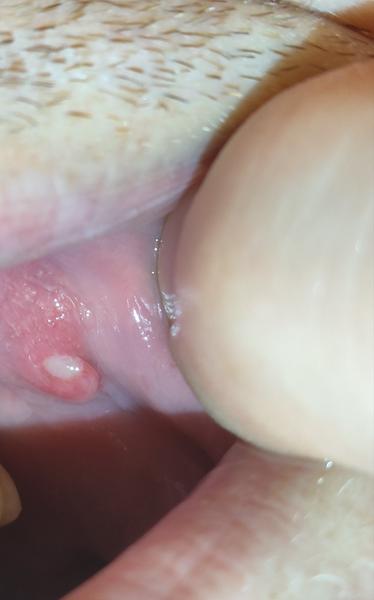 Ako riešiť bolestivý výrastok naplnený tekutinou na líci?