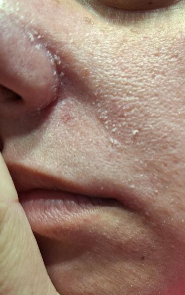 Čo pomáha na suchú šupinovú tvár?