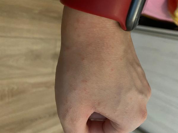 Čo spôsobuje takéto vyrážky na rukách?