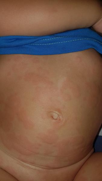 Vyrážky po celom tele (3r.)