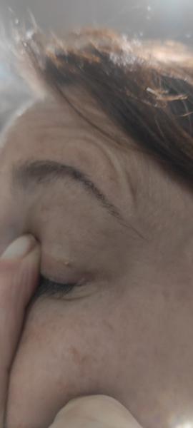 Biela trhlina na viečku: Ako riešiť tento problém?