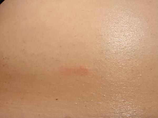 Môže to byť svrab?