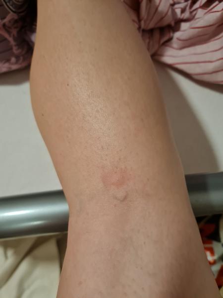 Kŕčová žila u 20-ročnej