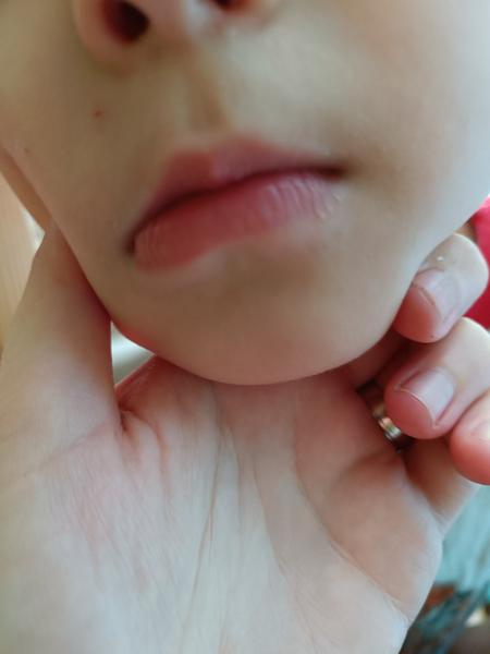 Je to herpes alebo niečo iné?