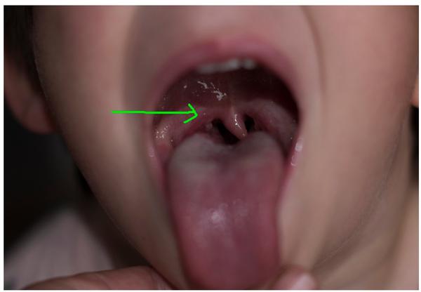 Infekcia atypickou mykobaktériou - zoonóza