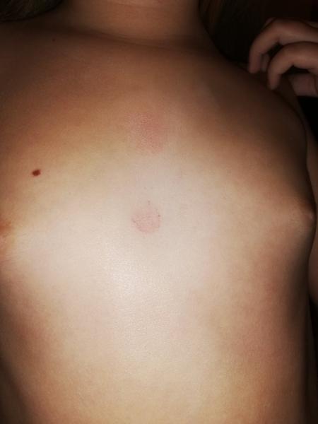 Aké fľaky to má moja 7 ročná dcéra na tele?