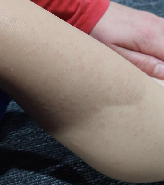 Môže byť vyrážka u detí príznakom alergie?