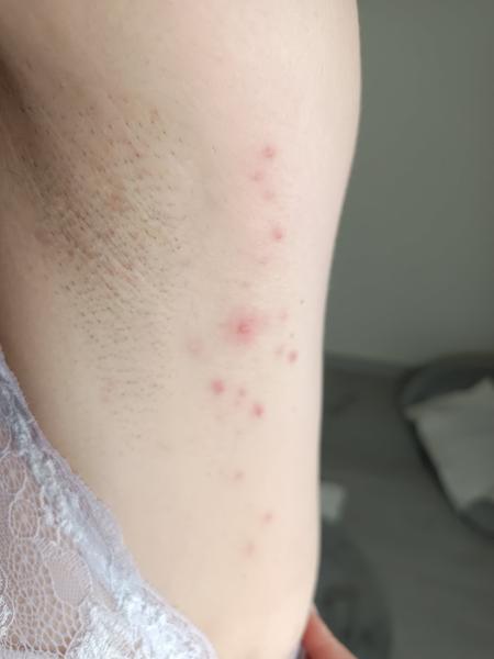 Príčina zvláštnych svrbivých vyrážok v nose a pod pazuchou